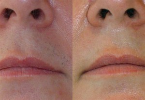 Facial Hair Removal in London