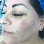 BB Glow Treatment