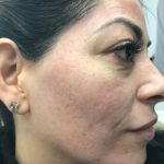 BB Glow Treatment
