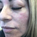 BB Glow Treatment
