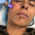 Microneedling
