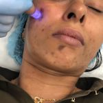 Microneedling