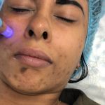 Microneedling